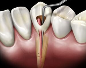 Root Canal Treatment