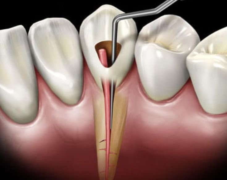 Root Canal Treatment