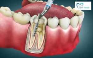 Root Canal Treatment