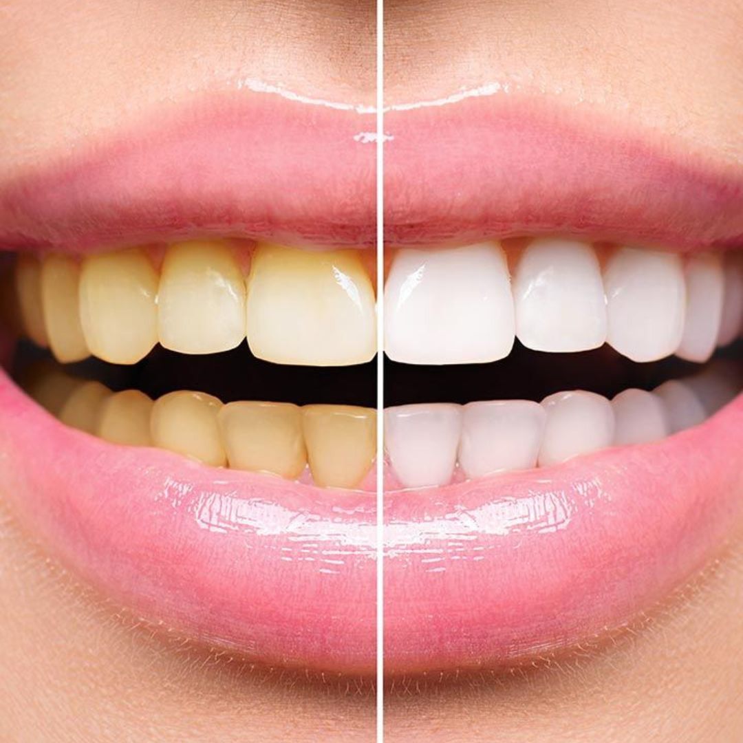 Teeth Whitening