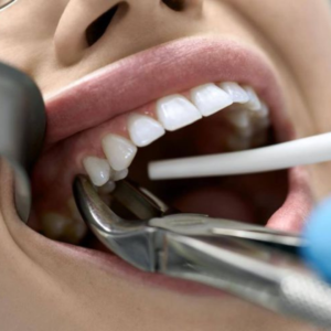 Tooth Extraction