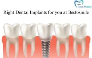 types of dental implants